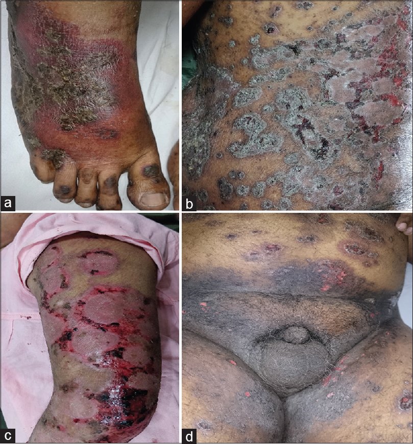 Acute methotrexate toxicity due to overdosing in psoriasis ...