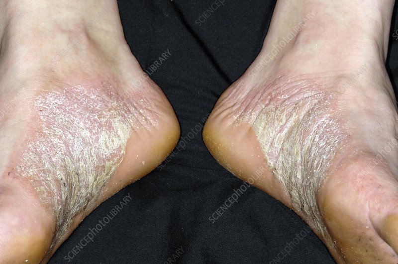 Acute psoriasis on the feet