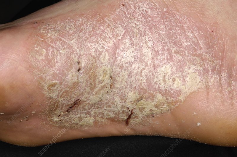 Acute psoriasis on the foot