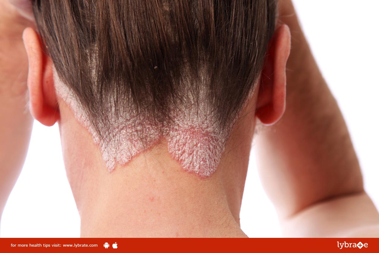 All About Scalp Psoriasis