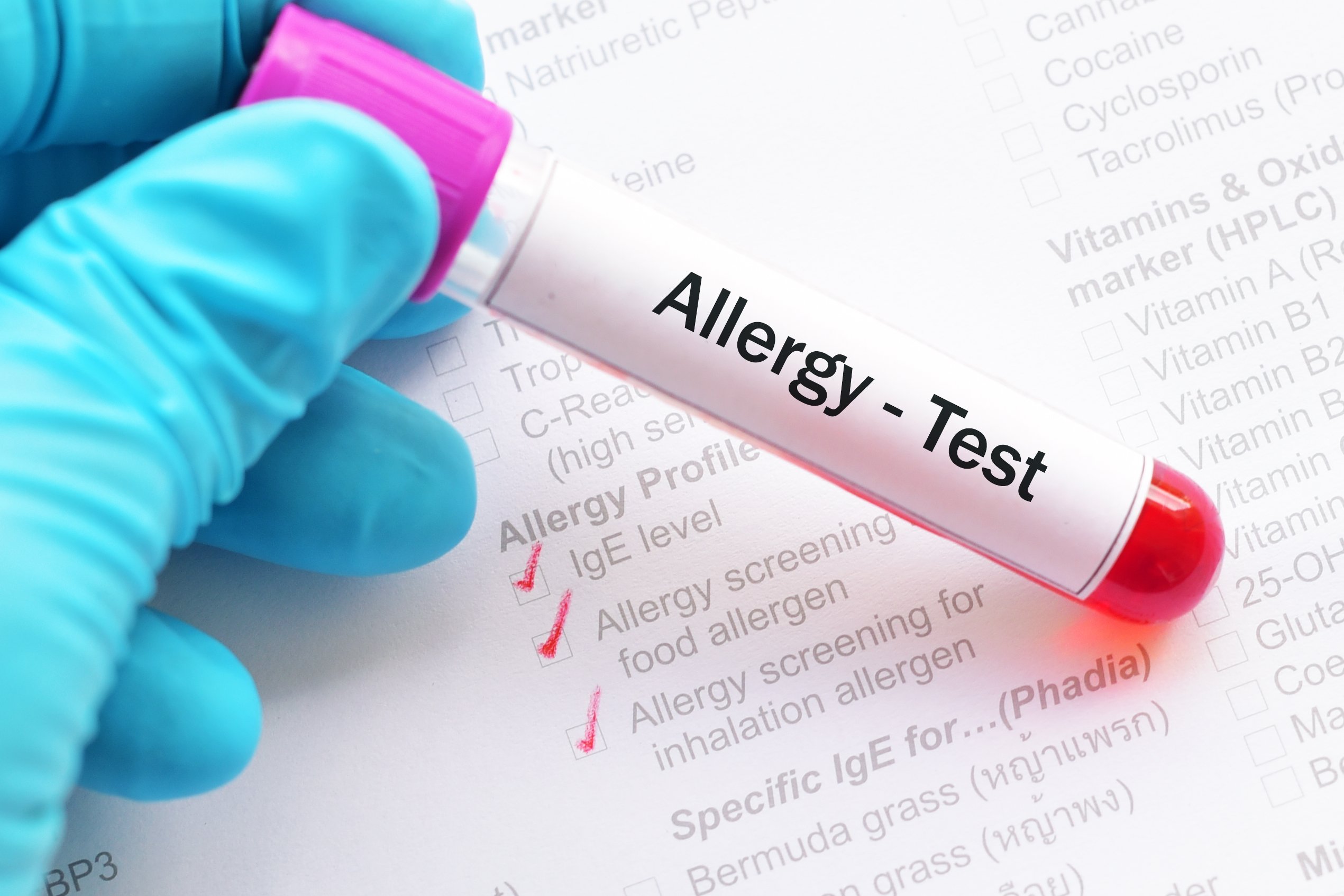 Allergy Testing