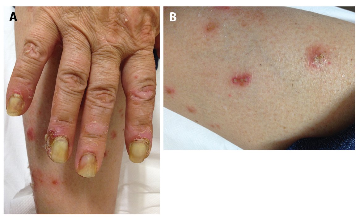 An Atypical Case of Pustular Psoriasis Presenting With Severe Subungual ...