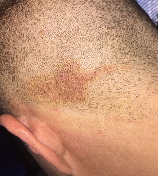 Any advice about this rash on my scalp? : Psoriasis