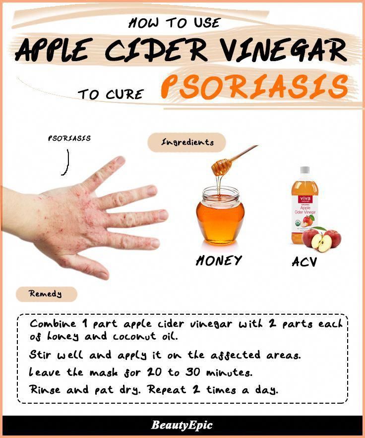 Apple Cider Vinegar for Psoriasis: Effective Remedies to ...