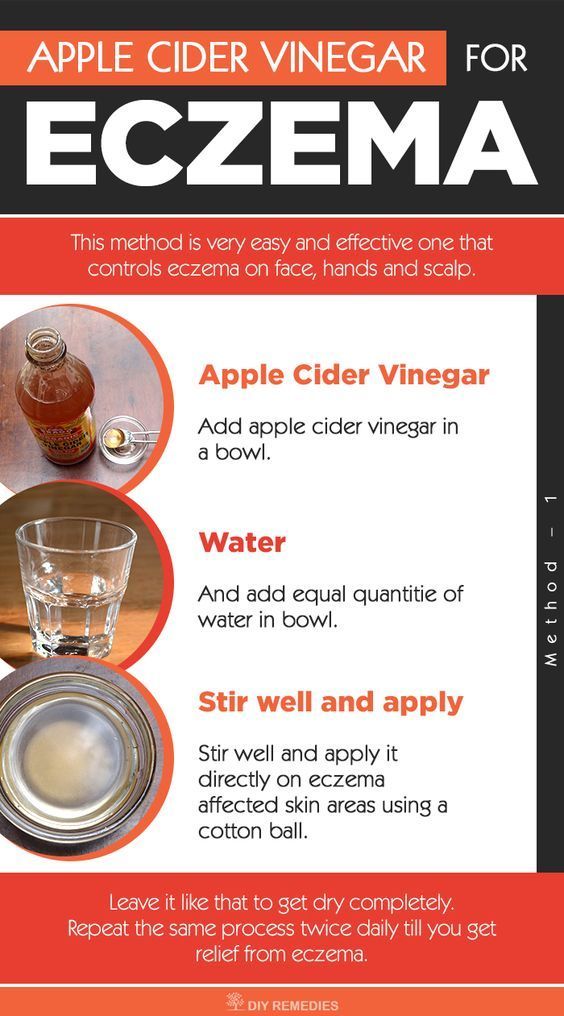Apple cider vinegar stands best in treating eczema with ...