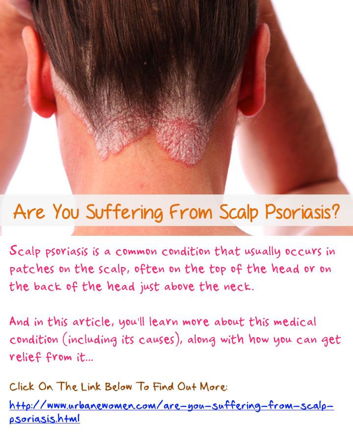 Are You Suffering From Scalp Psoriasis?
