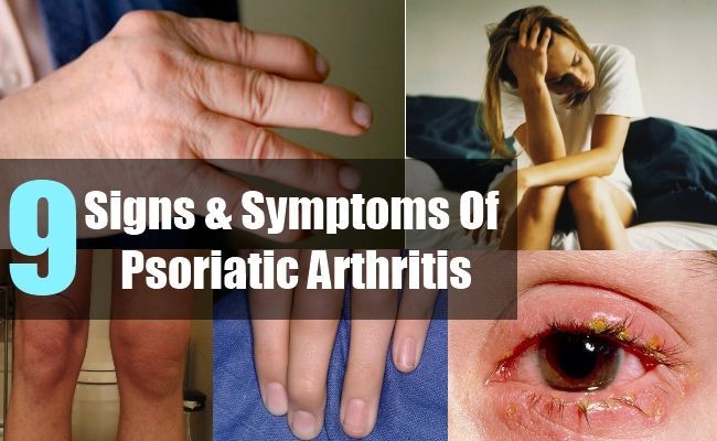 Arthropathic psoriasis, arthritis psoriatica, psoriatic ...