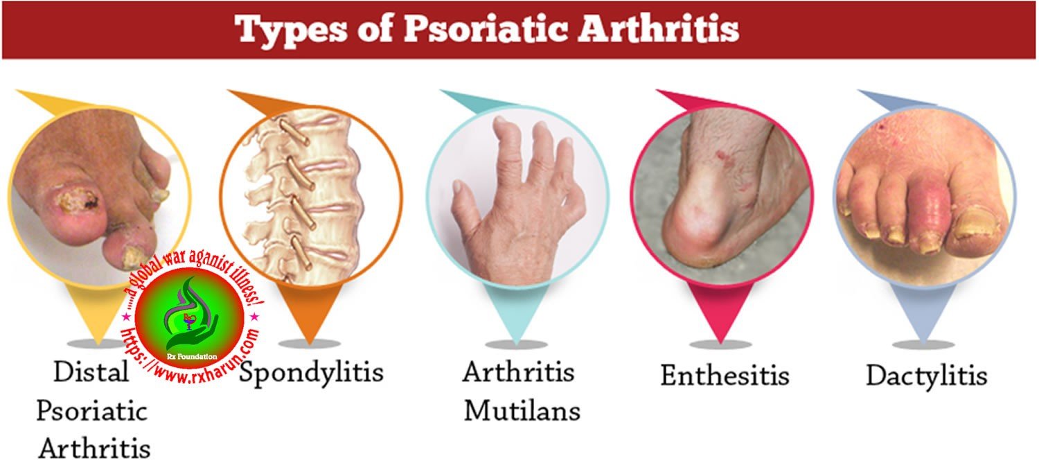 Arthropathic Psoriasis Vs Psoriatic Arthritis