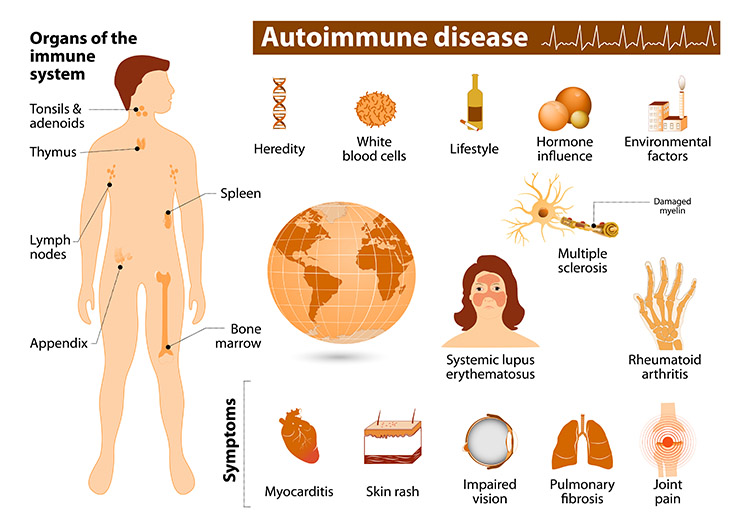 Autoimmune Diseases Basic information on the organs and the immune ...