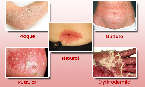 Ayurvedic Treatment for all Types of Psoriasis by Kayakalp