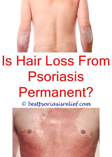 Bee Venom Therapy For Psoriasis