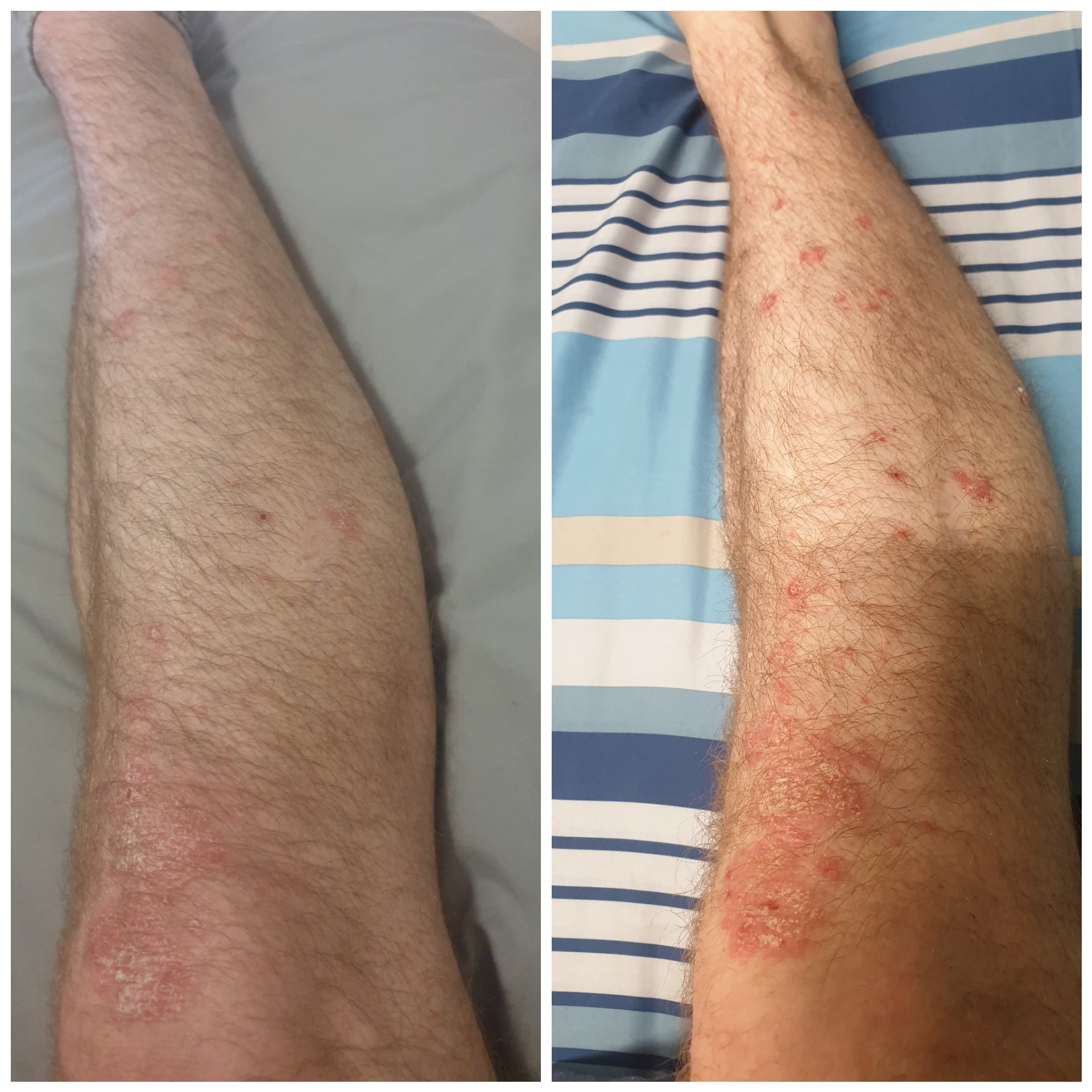 Before and after flight to work. : Psoriasis