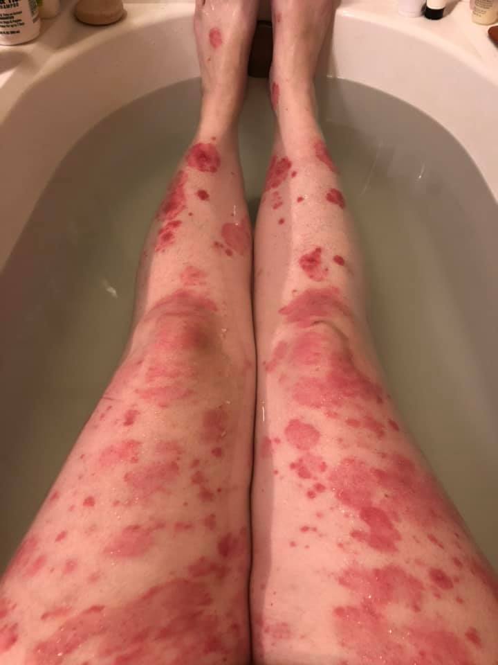 Best Biologic Psoriasis Medicine (PICTURES And Reviews)