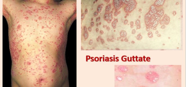 Best Body Wash For Guttate Psoriasis