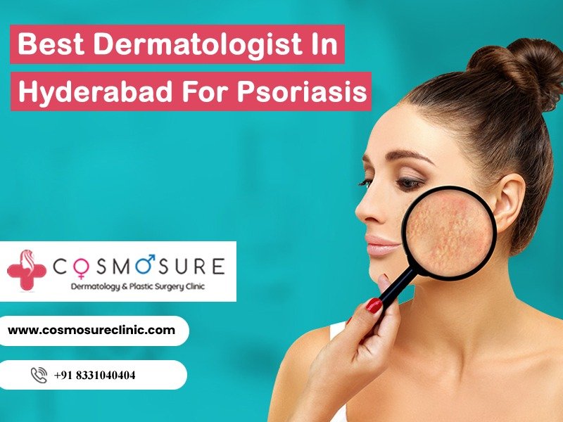 Best Dermatologist In Hyderabad For Psoriasis