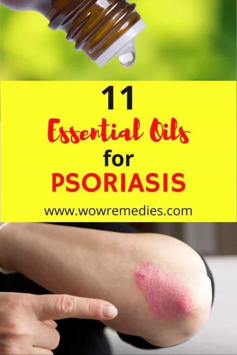 Best Essential Oils For Psoriasis