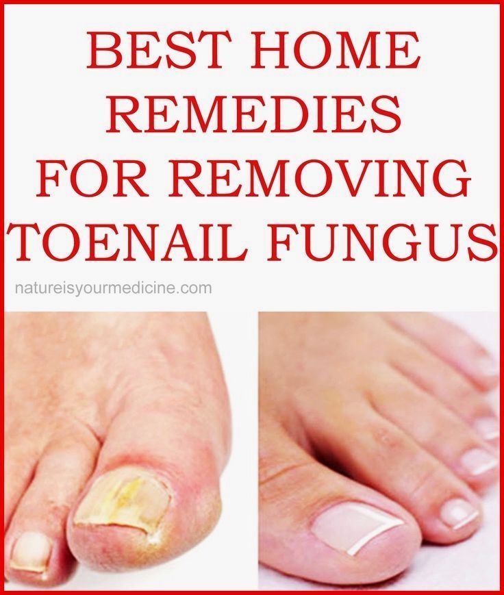 BEST HOME REMEDIES FOR REMOVING TOENAIL FUNGUS #NailFunguscurefinger ...