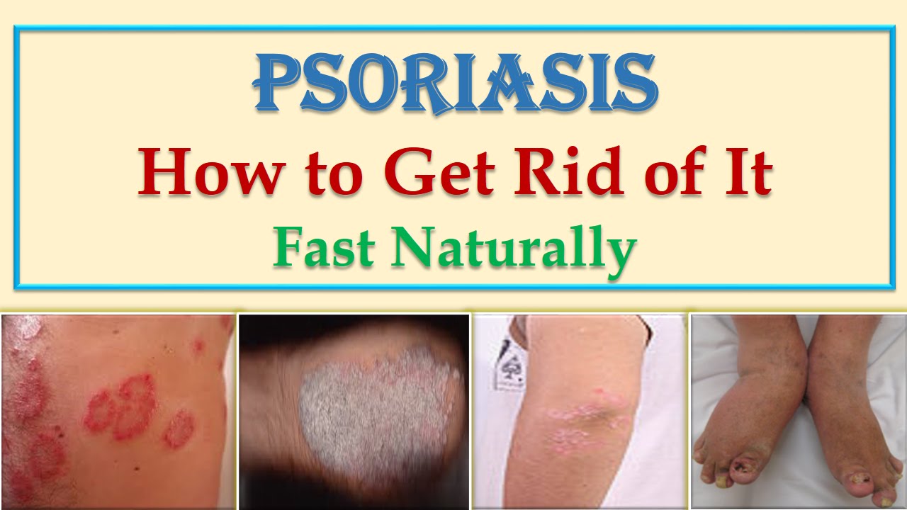 Best Natural Home Remedies and Cures for Scalp and Skin Psoriasis ...