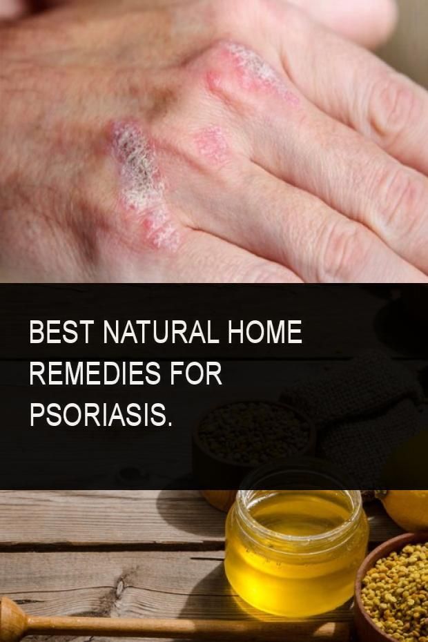 Best Natural Home Remedies for Psoriasis. #Psoriasis # ...