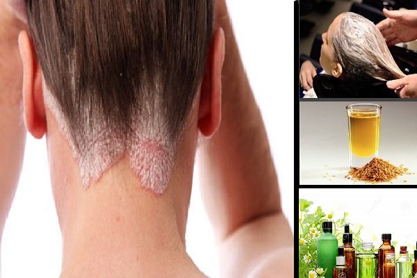 Best Natural Psoriasis Scalp Treatment at Home