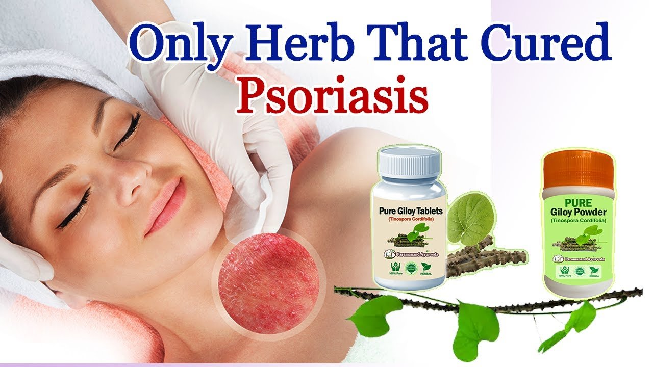 Best Permanent Cure For Psoriasis