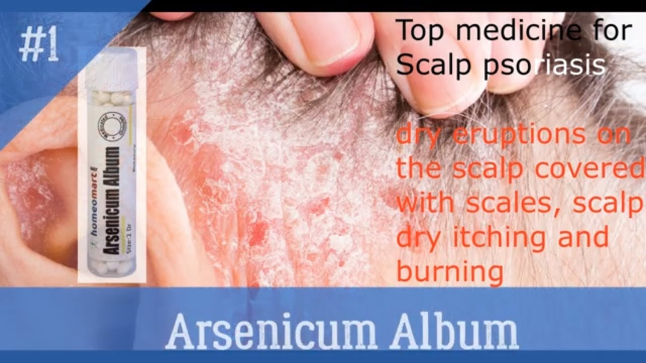 Best Scalp psoriasis treatment in homeopathy