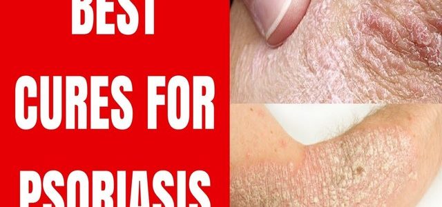 Best Treatment For Psoriasis On Elbow