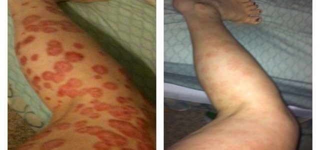 Best Treatment For Psoriasis On Legs