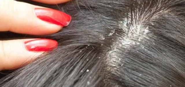Best Treatments For Scalp Psoriasis
