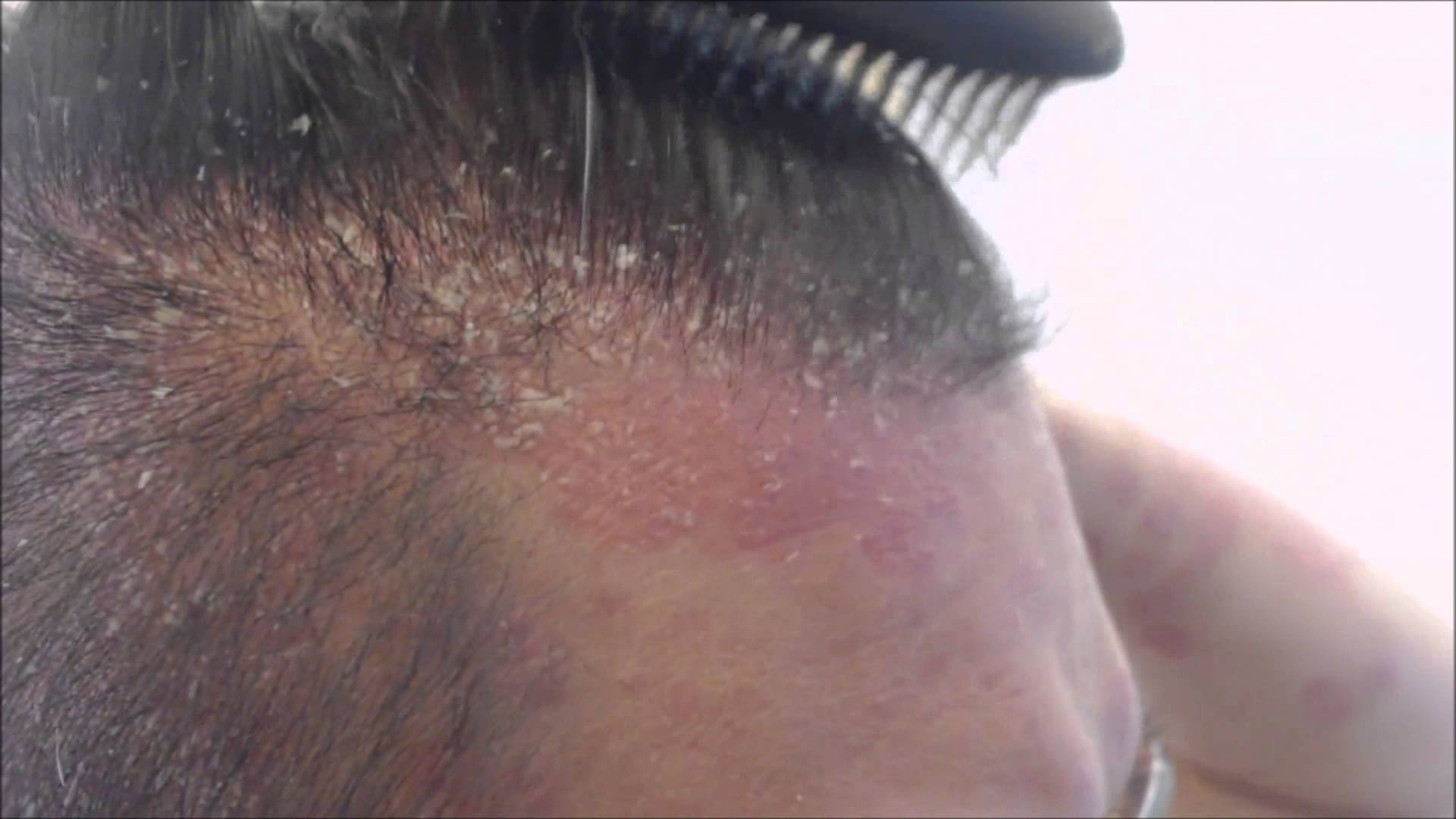 Best ways to get rid of Hair psoriasis follow the remedies
