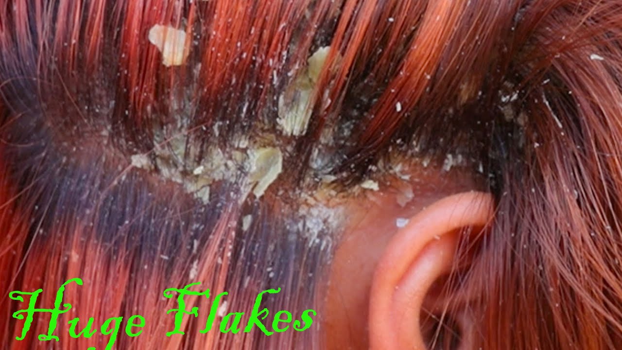 BIG FLAKES Itchy Psoriasis Scalp Dandruff combing # 56 ...