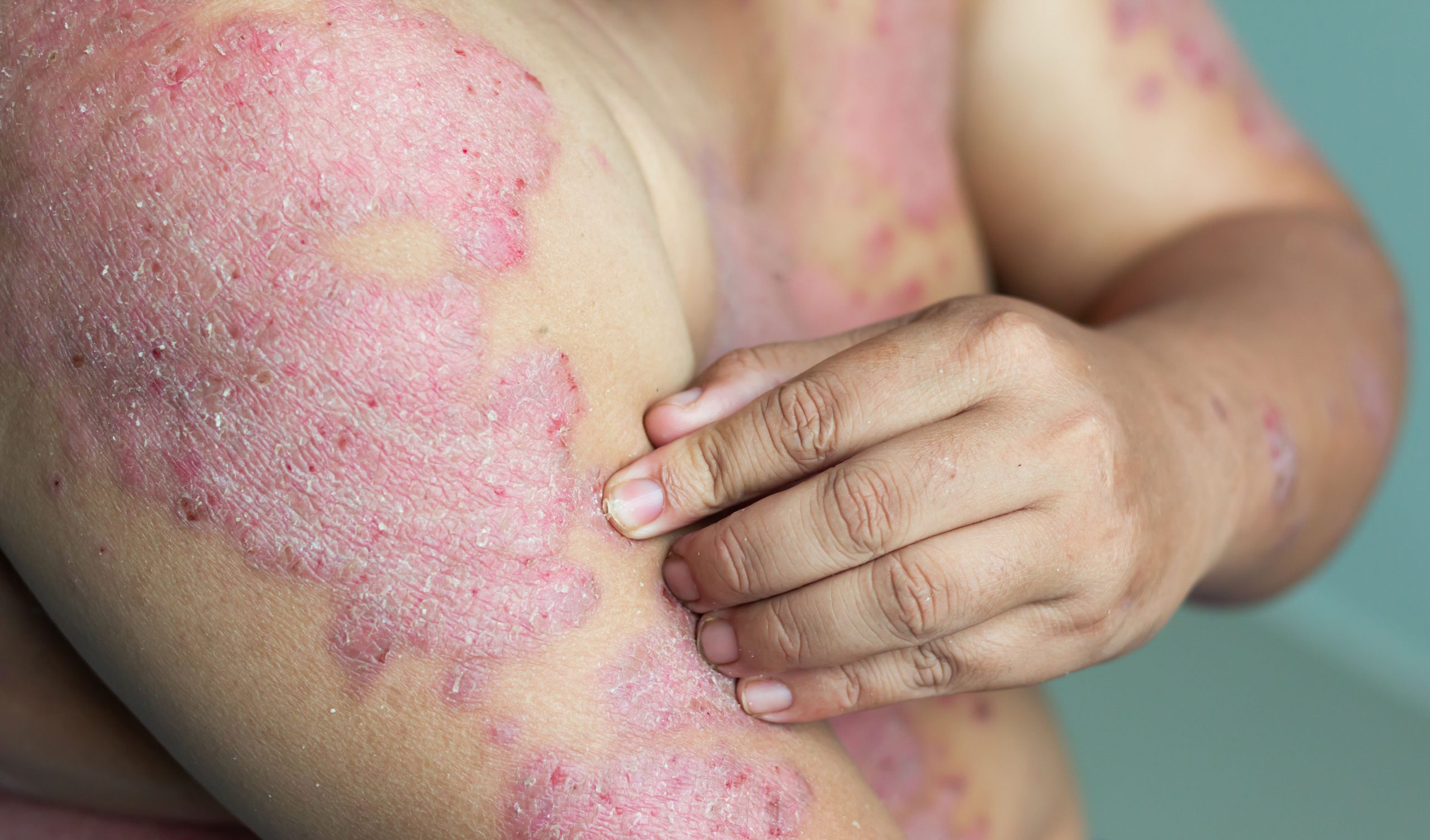 Biologics make psoriasis clearance a real possibility ...