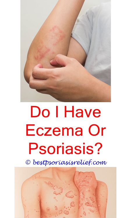 Boiled Eggs Psoriasis