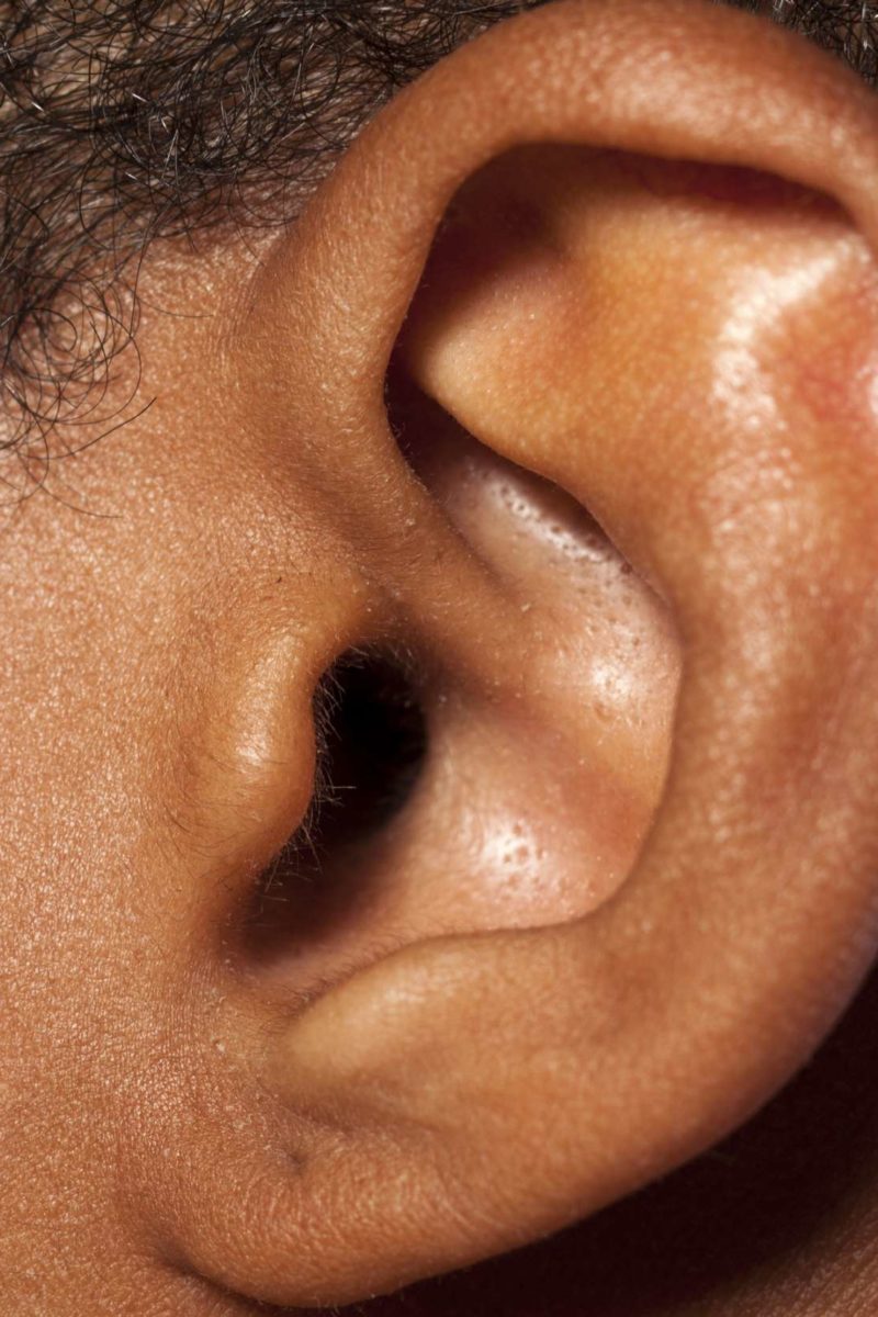 Bug in ear: Symptoms and how to get it out