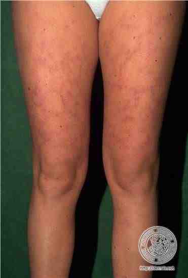 Can Arthritis Be Itchy Pain Leg Psoriatic ...