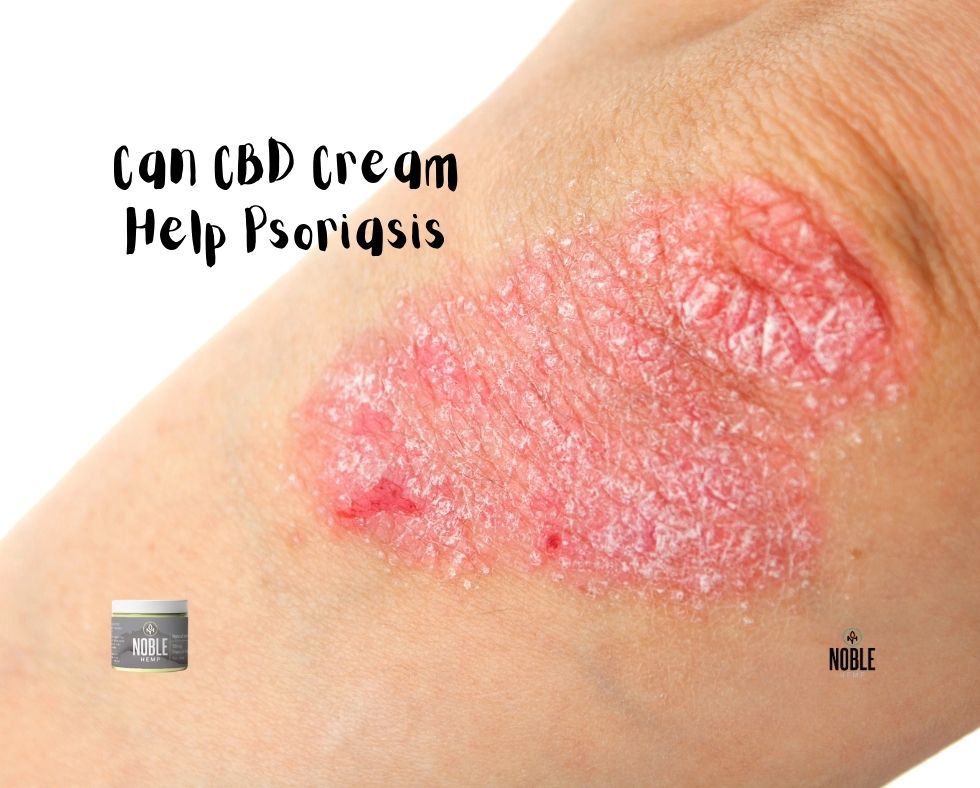 Can CBD Cream Help Psoriasis