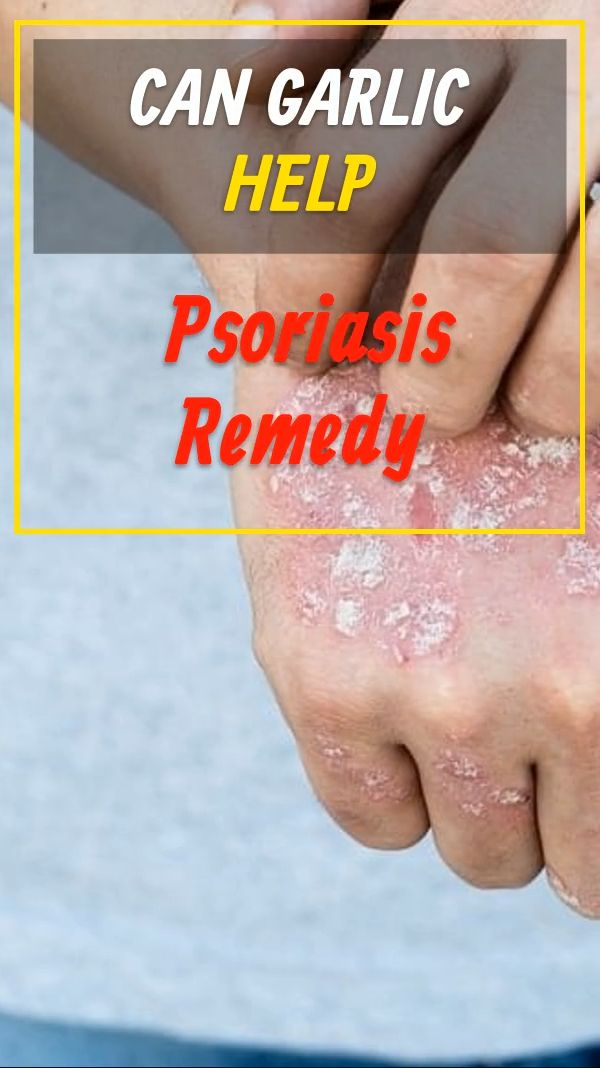 Can Garlic Help Psoriasis Remedy in 2020