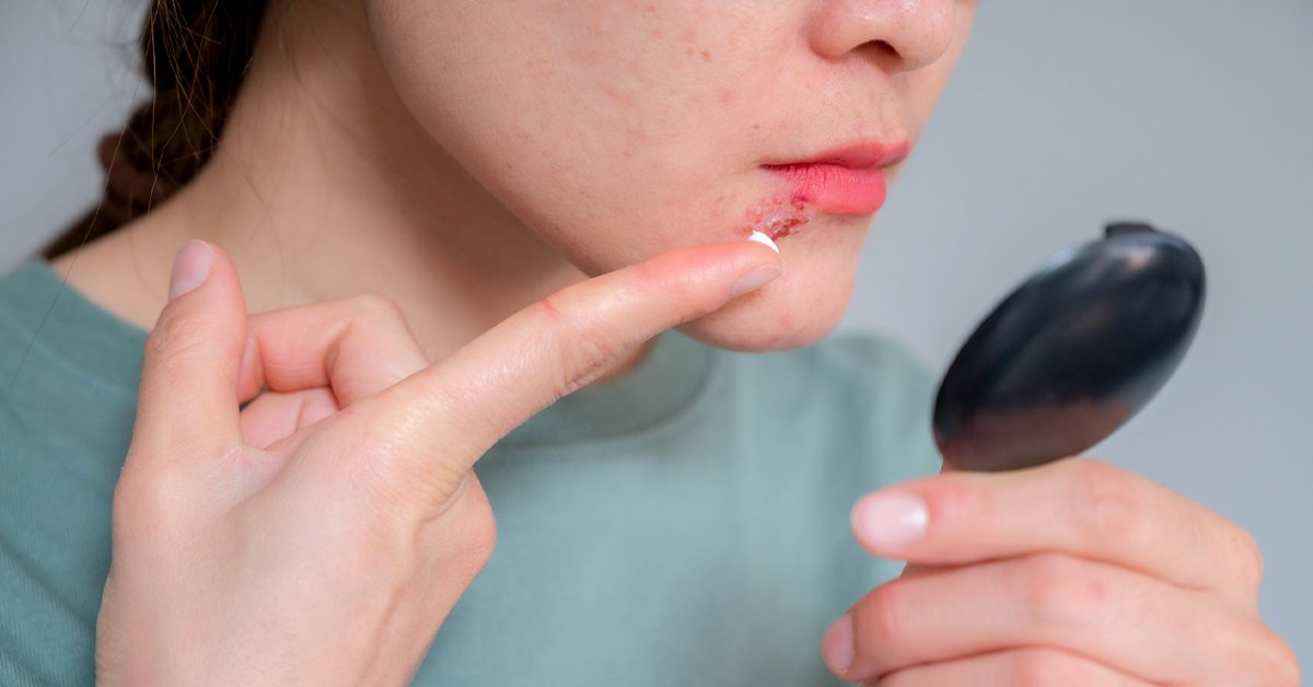 Can Psoriasis Affect Your Lips?