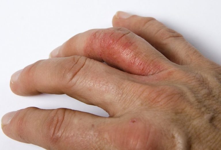 Can Psoriasis Spread By Irritating The Affected Areas?