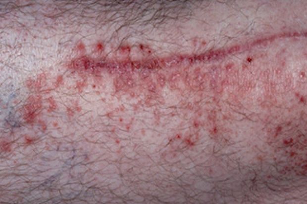 Can Psoriasis Spread By Irritating The Affected Areas ...