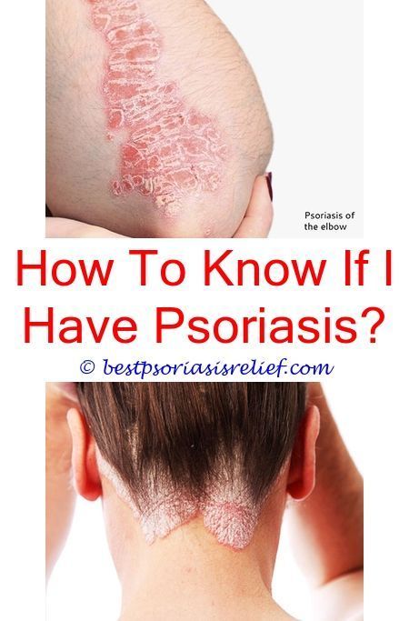 Can You Dye Your Hair If You Have Scalp Psoriasis