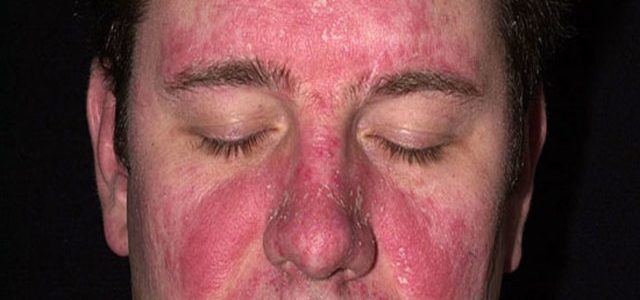 Can You Get Plaque Psoriasis On Your Face
