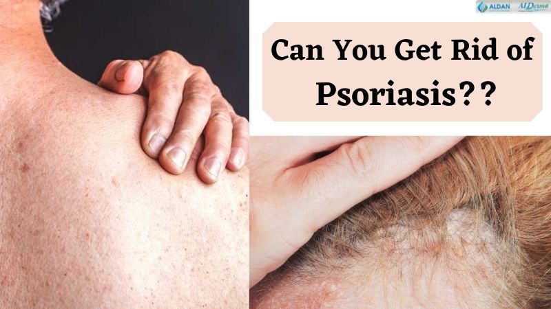 Can You Get Rid Of Psoriasis? How to Cure Psoriasis Permanently?