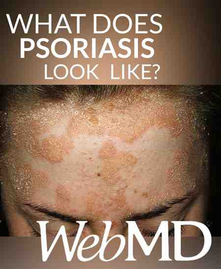 Can You Have Psoriasis On Your Neck Dry Skin Face