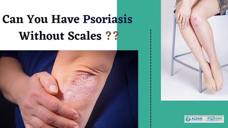 Can You Have Psoriasis Without Scales