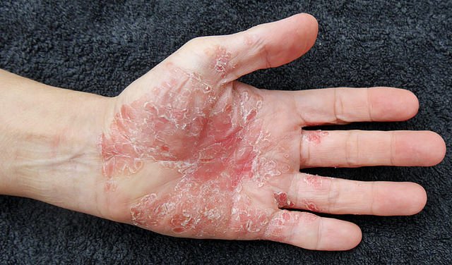 Causes of Psoriasis and How to Treat it with Diet and ...