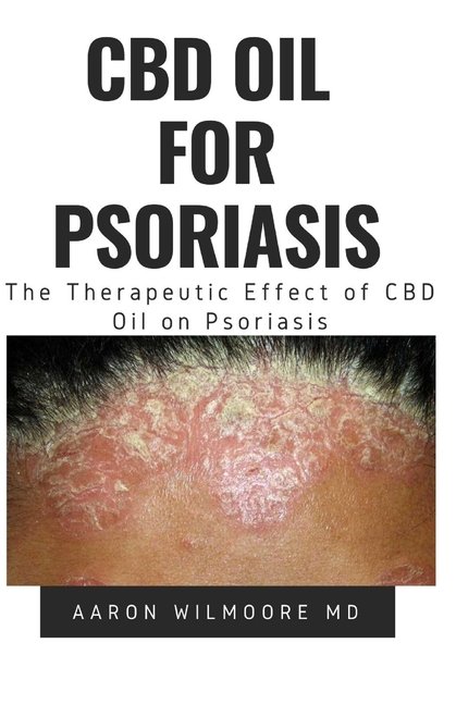 CBD Oil for Psoriasis: All You Need To Know About How CBD ...