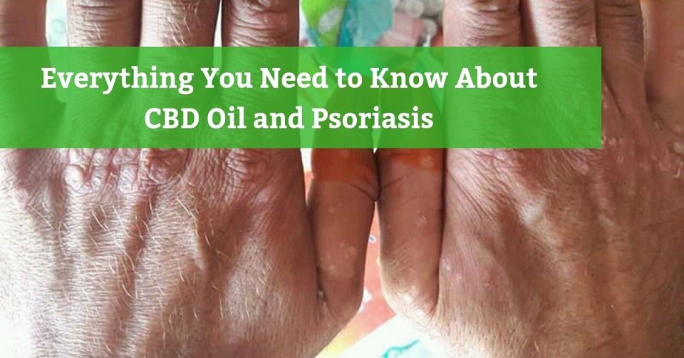 Cbd Oil Psoriasis Before And After » CBD Oil Treatments