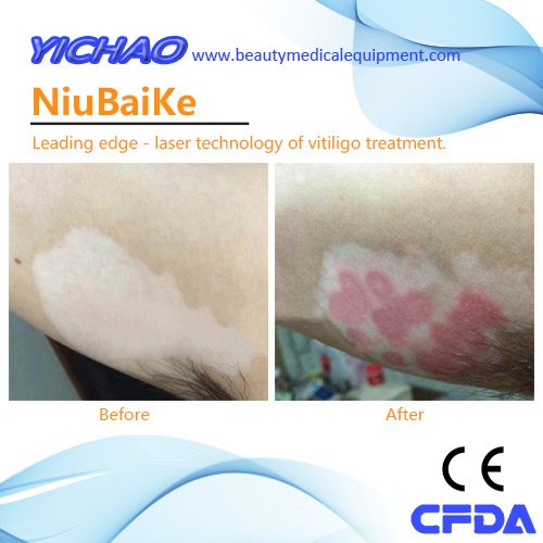 China 308nm UV Laser Psoriasis Vitiligo Full Body ...