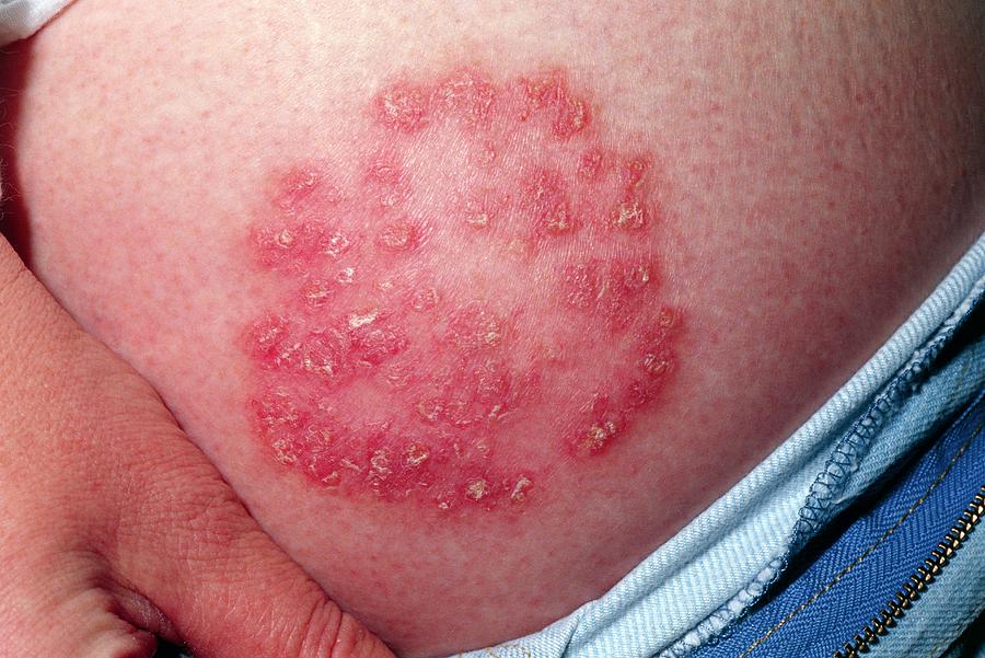 Chronic Plaque Psoriasis Photograph by Dr H.c.robinson / Science Photo ...